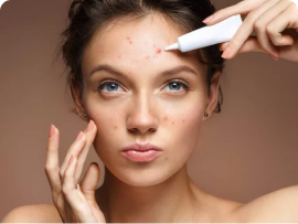 Girl with acne