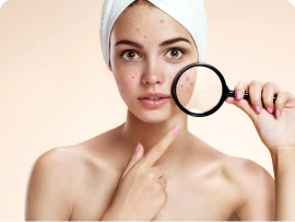 Girl with acne